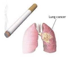 Стремление жить - Курение вызывает рак! | Фонд Инна