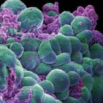 Стремление жить - Новая технология позволит выявить устойчивые к химиотерапии раковые клетки | Фонд Инна - Благотворительный фонд помощи онкобольным