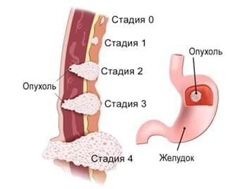 Новости - Как избежать рака желудка? Способ есть! | Фонд Инна - Благотворительный фонд помощи онкобольным