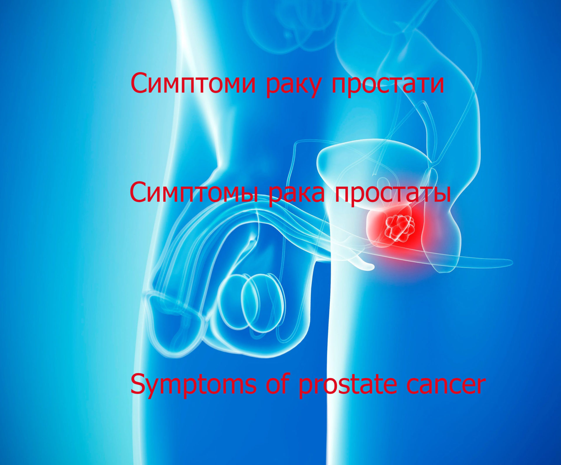 Симптомы рака простаты. Видео - Фонд Инна — Благотворительный фонд помощи  онкобольным
