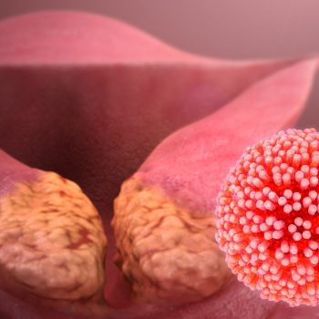 Стремление жить - Вирус HPV вызывает рак! | Фонд Инна - Благотворительный фонд помощи онкобольным