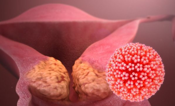 Стремление жить - Вирус HPV вызывает рак! | Фонд Инна